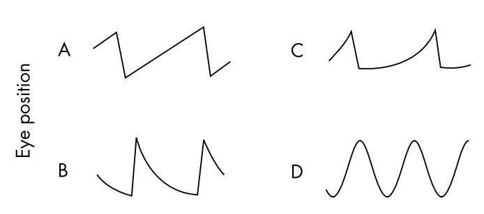 Common waveforms of nystagmus. B shows a negative exponential time course, with decreasing velocity.