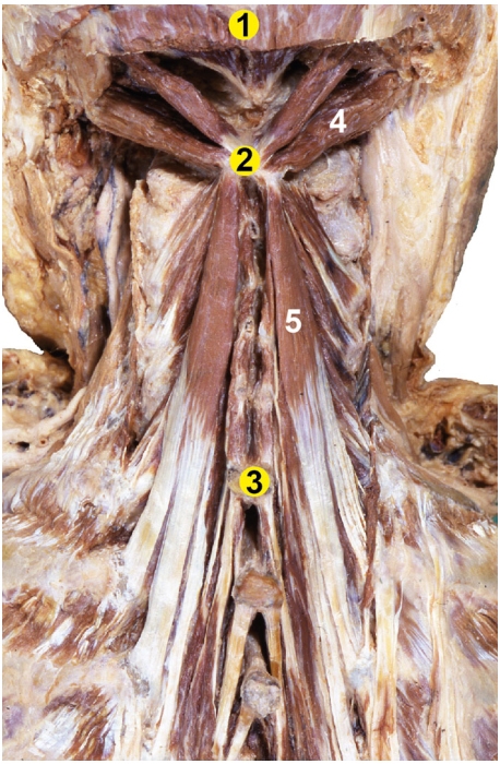 Gross Anatomy: Insertion and Origin of Semispinalis Cervicis muscle (#5)