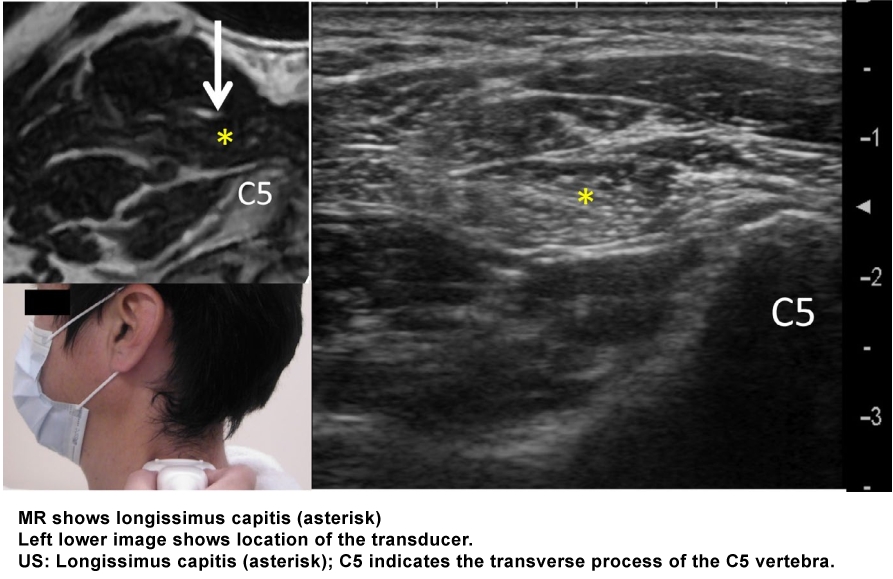 Ultrasound approach for Longissimus capitis muscle