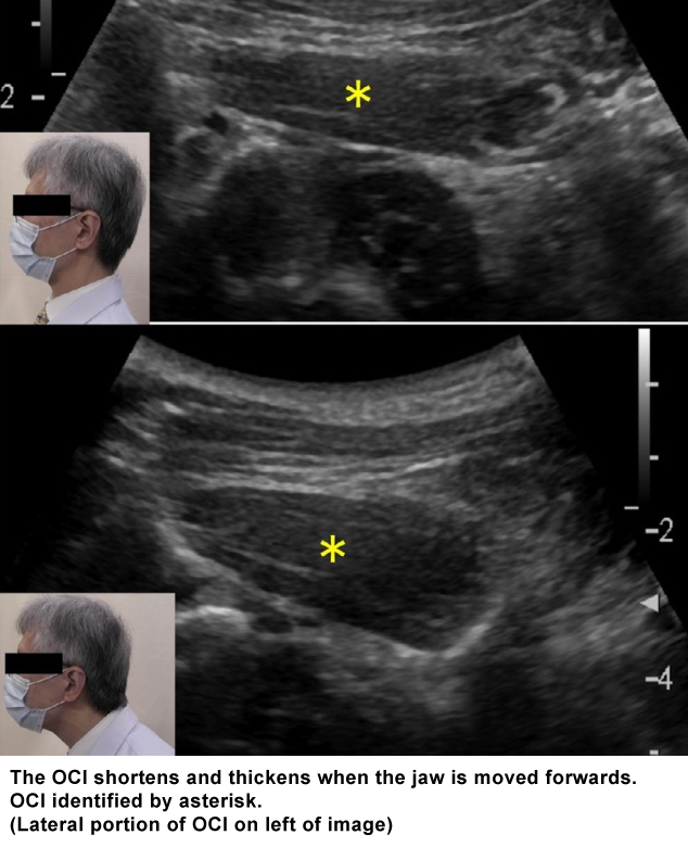 Ultrasound: Activation of OCI