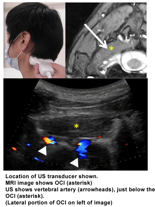 Ultrasound: Demonstration of OCI