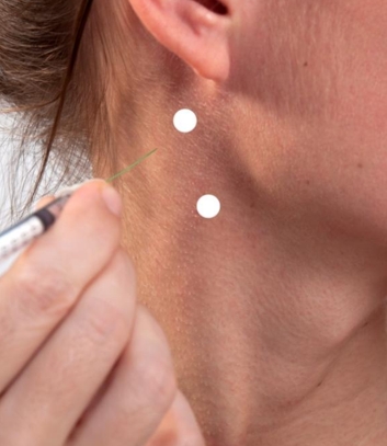 Surface Anatomy: Injection Sites for Sternocleidomastoid muscle