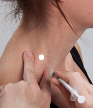 Surface Anatomy: Injection Sites for Scalenus muscle