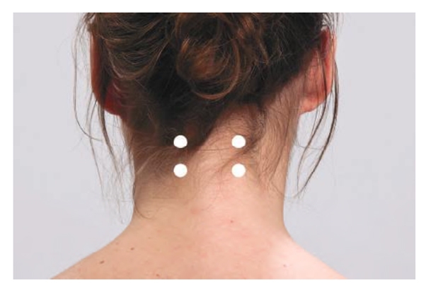Surface Anatomy: Injection Sites for Semispinalis capitis muscle