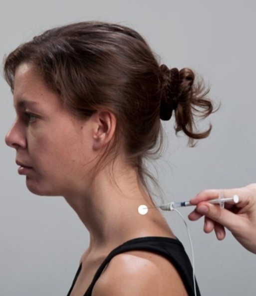 Surface Anatomy: Injection Sites for Trapezius muscle