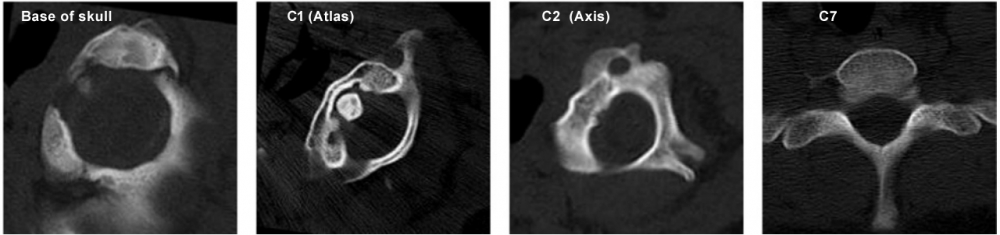 CT imaging of cervical spine
