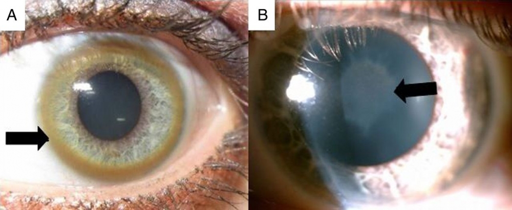Kayser-Fleischer ring and Sunflower cataract