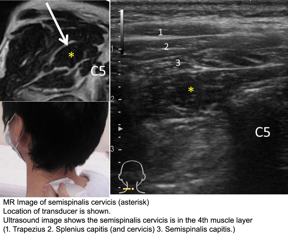 Ultrasound approach to Semispinalis Cervicis  muscle
